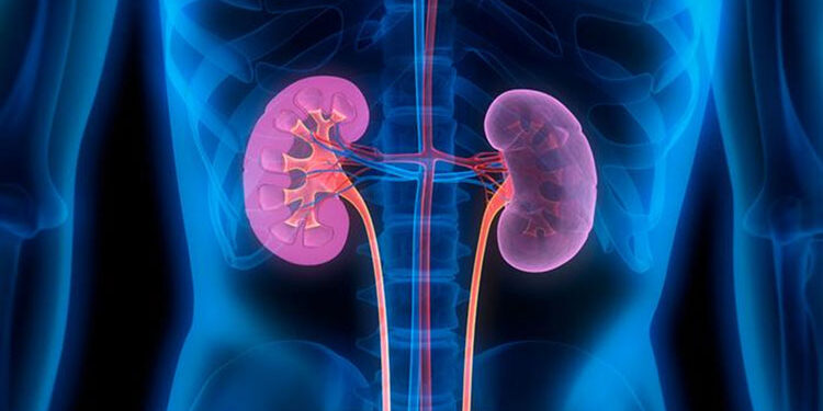 علامات تكشف الإصابة بحصوات الكلى