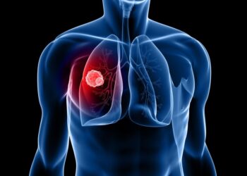 السويد تخفض وفيات سرطان الرئة بنسبة 42% خلال عقد واحد