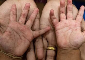 الصحة تطمئن أولياء الأمور بعدم وجود خطورة من مرض “اليد والفم والقدم”